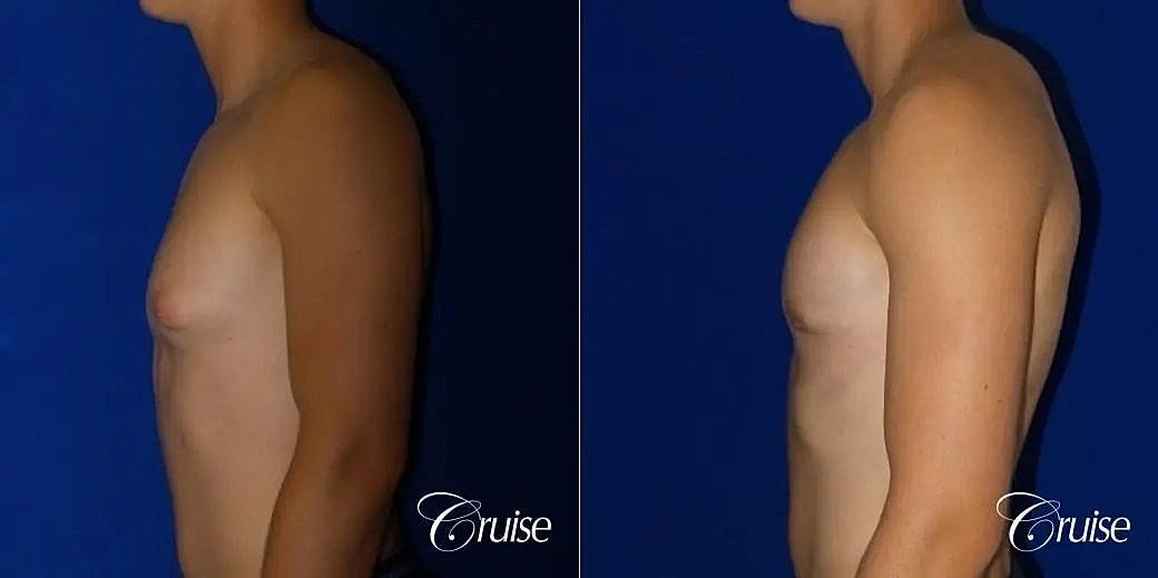Gynecomastia Before & After