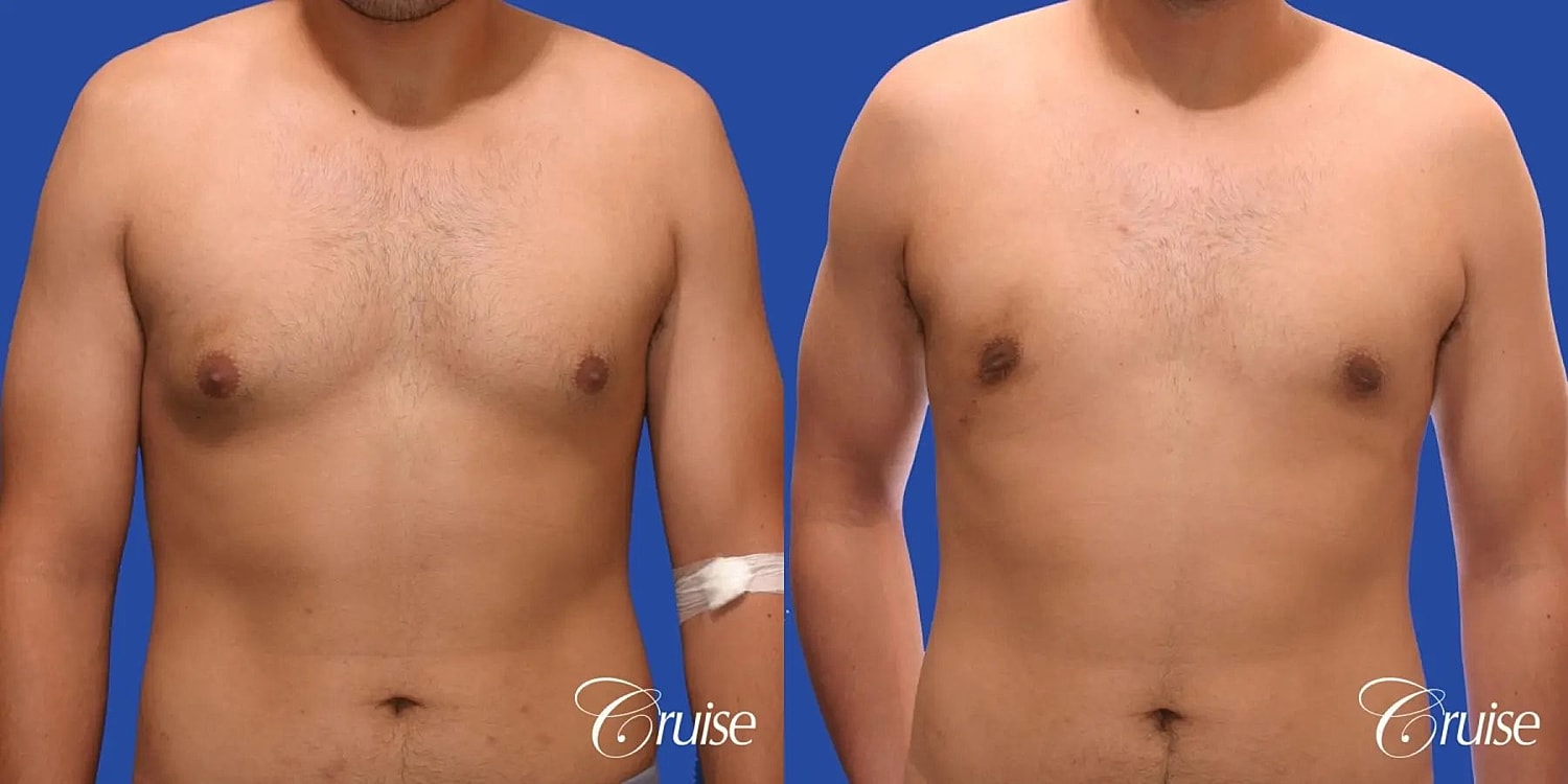 Gynecomastia Before & After