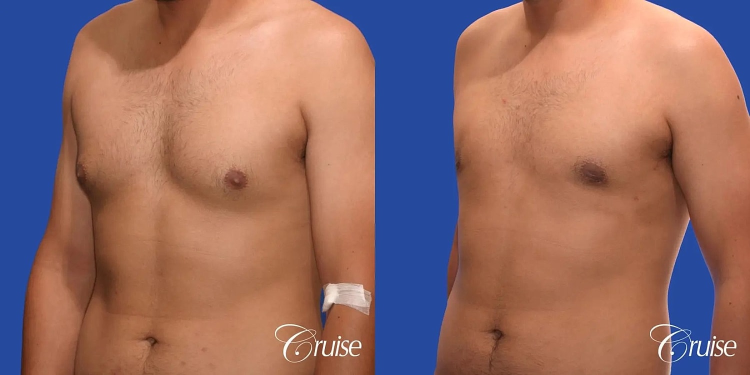 Gynecomastia Before & After