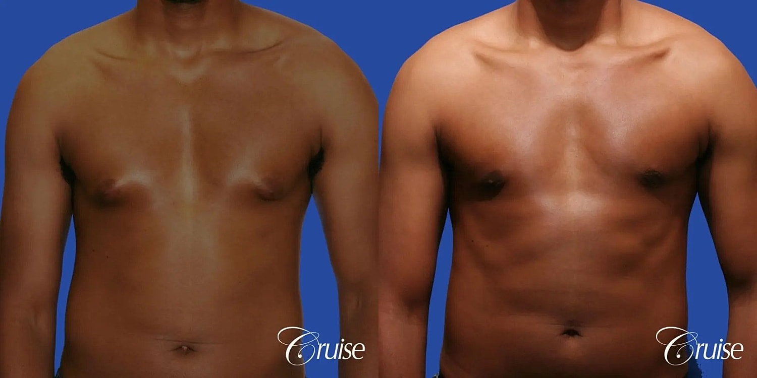 Gynecomastia Before & After