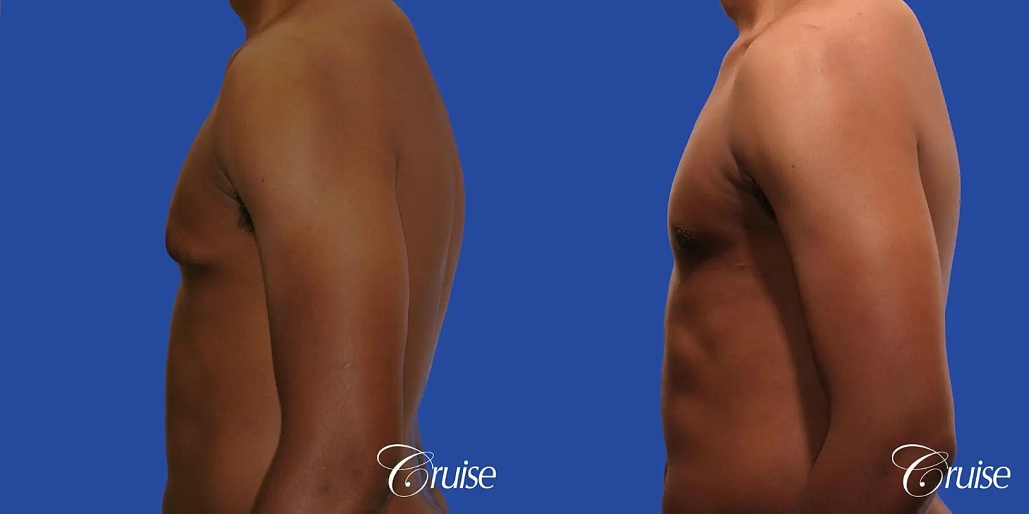 Gynecomastia Before & After