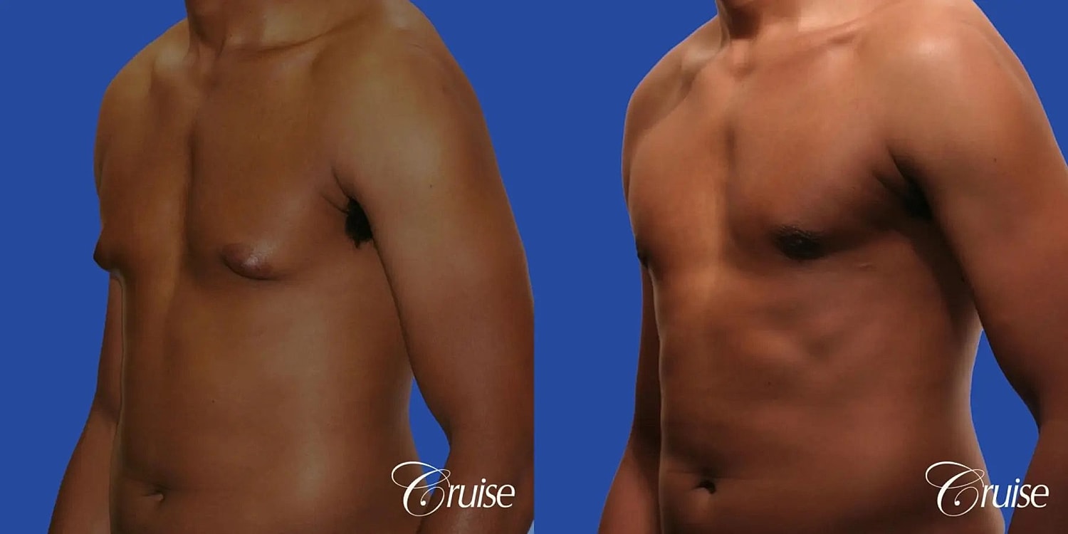 Gynecomastia Before & After