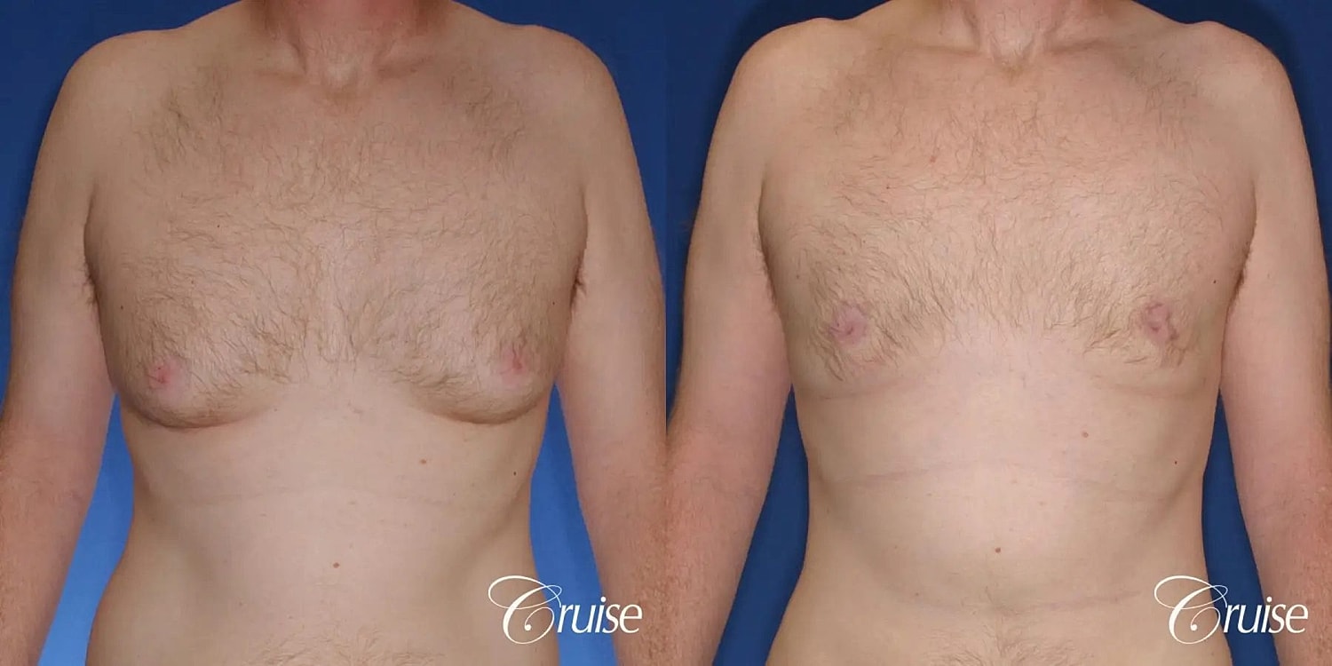 Gynecomastia Before & After