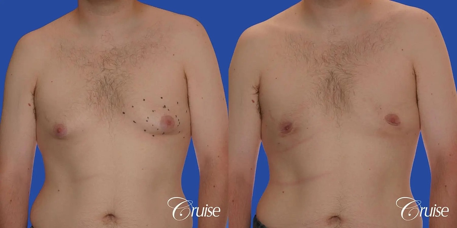 Gynecomastia Before & After