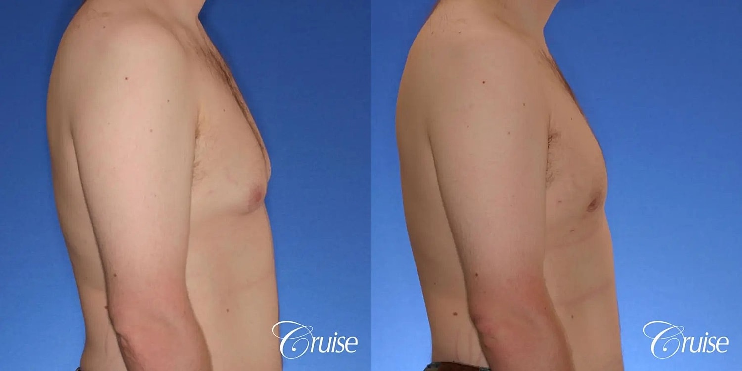 Gynecomastia Before & After