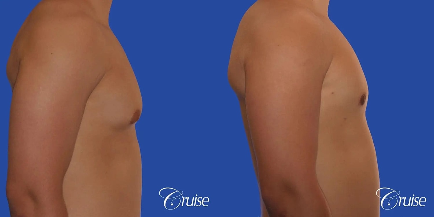 Gynecomastia Before & After