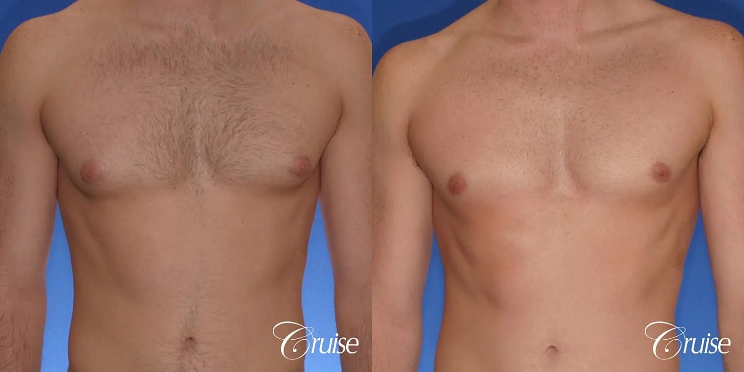 Gynecomastia Before & After