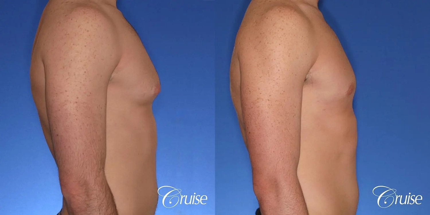 Gynecomastia Before & After