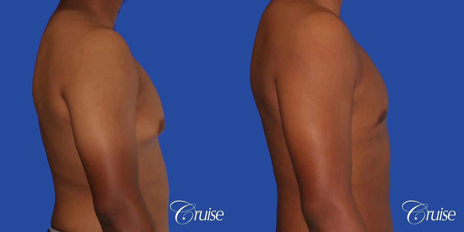 Gynecomastia Before & After