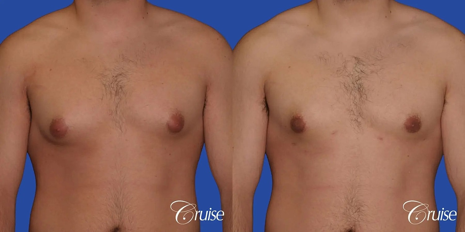 Gynecomastia Before & After