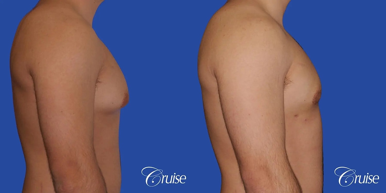 Gynecomastia Before & After