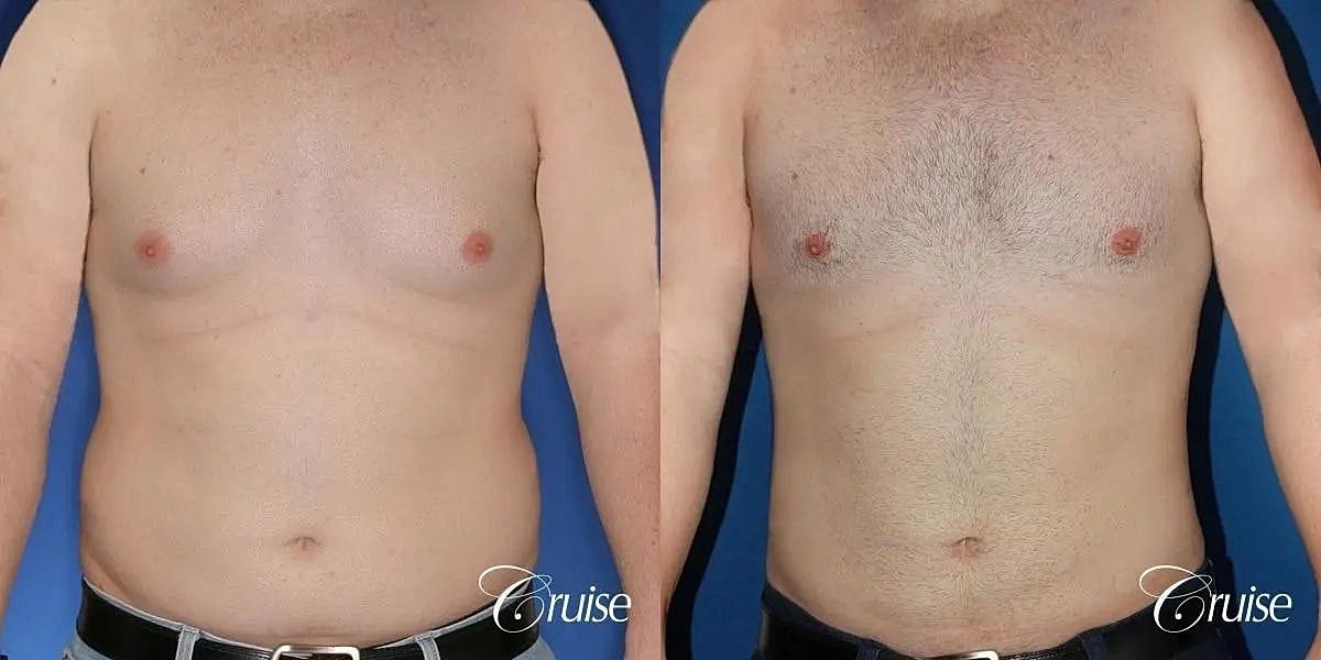 Gynecomastia Before & After
