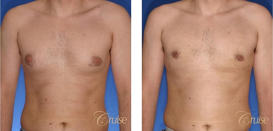 Type 2 Gynecomastia Before & After