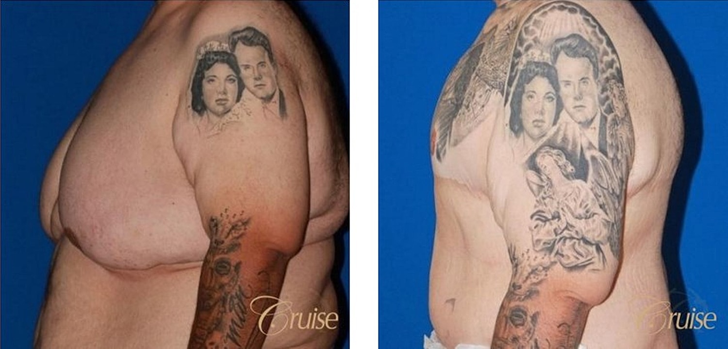 Type 6 Gynecomastia Before & After