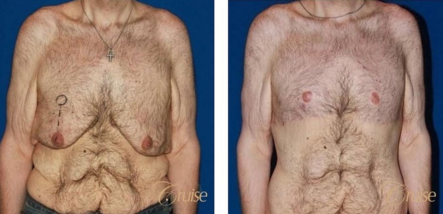 Type 6 Gynecomastia Before & After