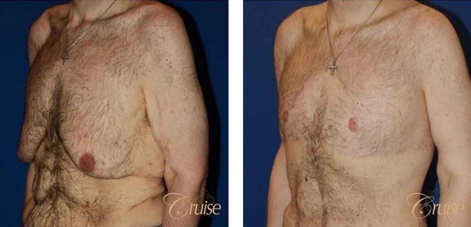 Type 6 Gynecomastia Before & After