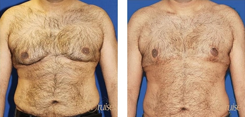 Type 5 Gynecomastia Before & After