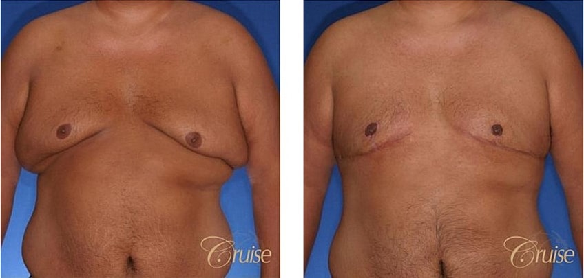 Type 5 Gynecomastia Before & After