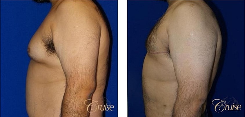 Type 5 Gynecomastia Before & After