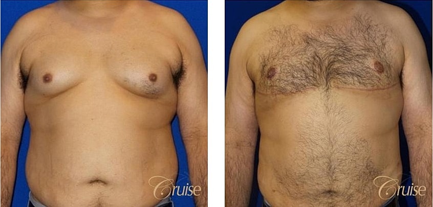 Type 5 Gynecomastia Before & After