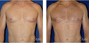 Type 3 Gynecomastia Before & After