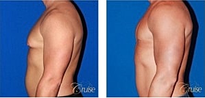 Type 3 Gynecomastia Before & After