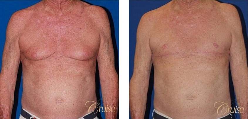 Type 4 Gynecomastia Before & After