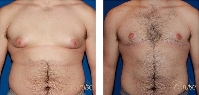 Type 4 Gynecomastia Before & After