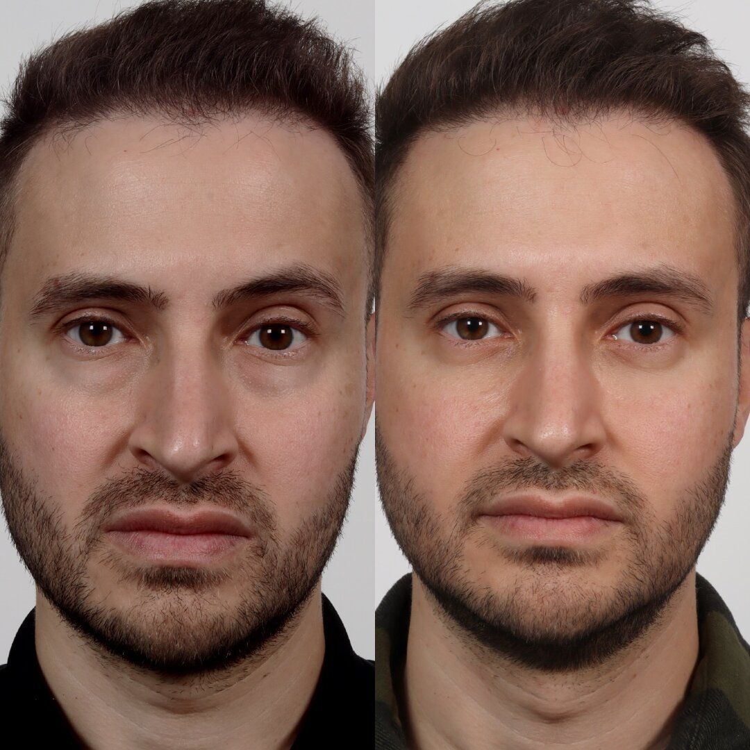  Before & After