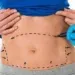 Best Abdominoplasty Option In Houston TX