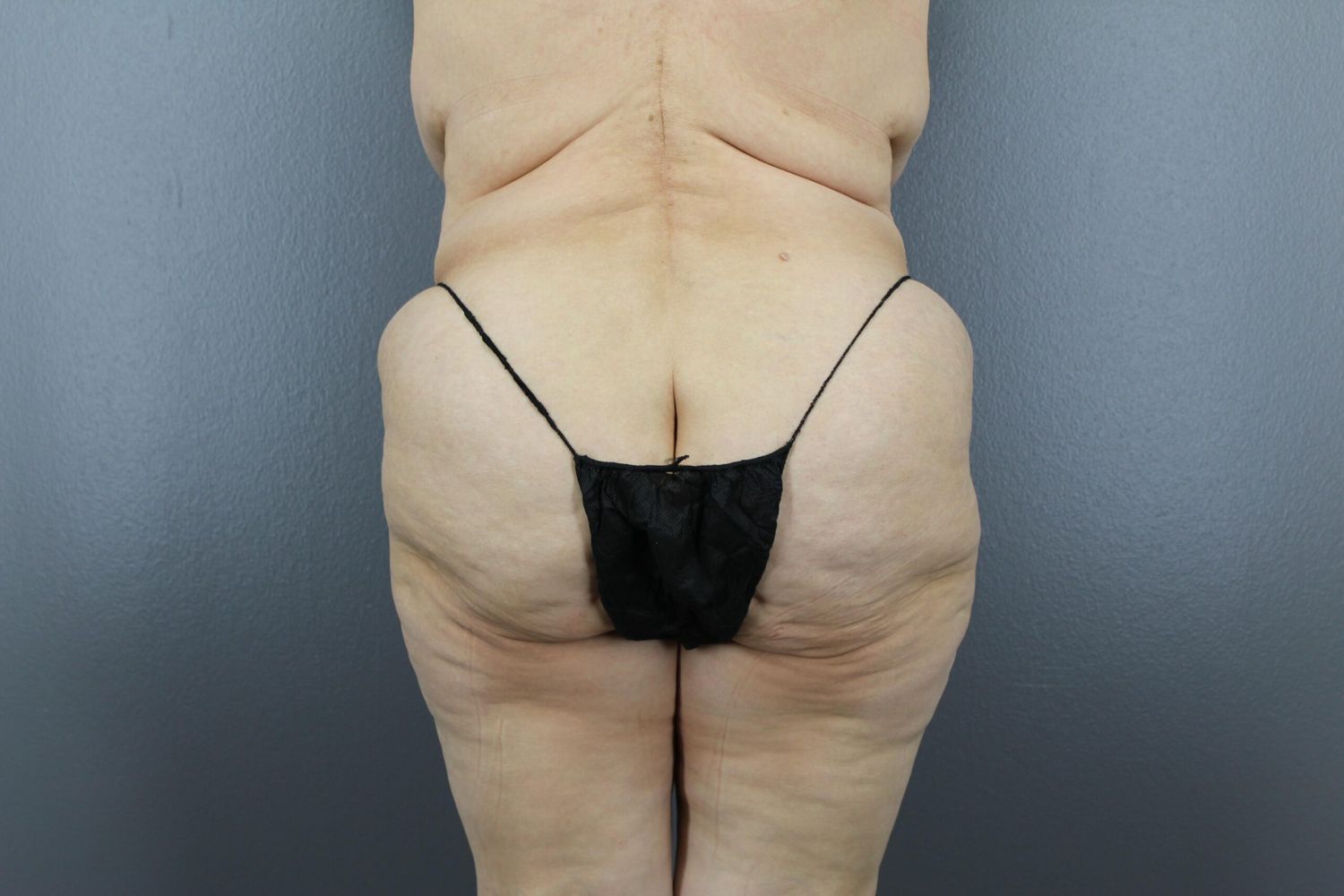 Tummy Tuck Before & After