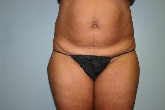 Tummy Tuck Before & After