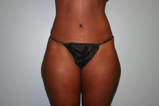 Tummy Tuck Before & After