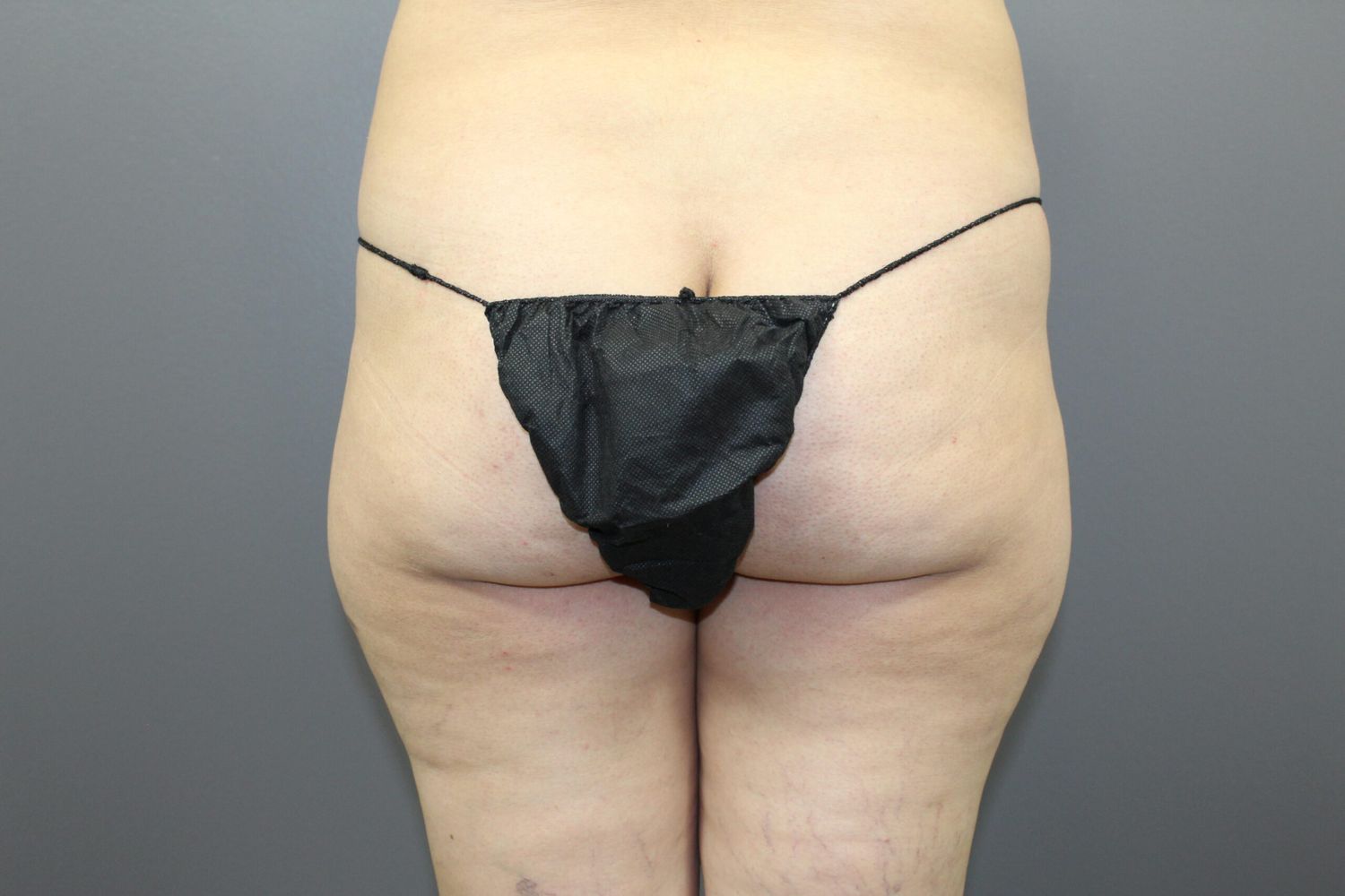 Body Contouring Before & After