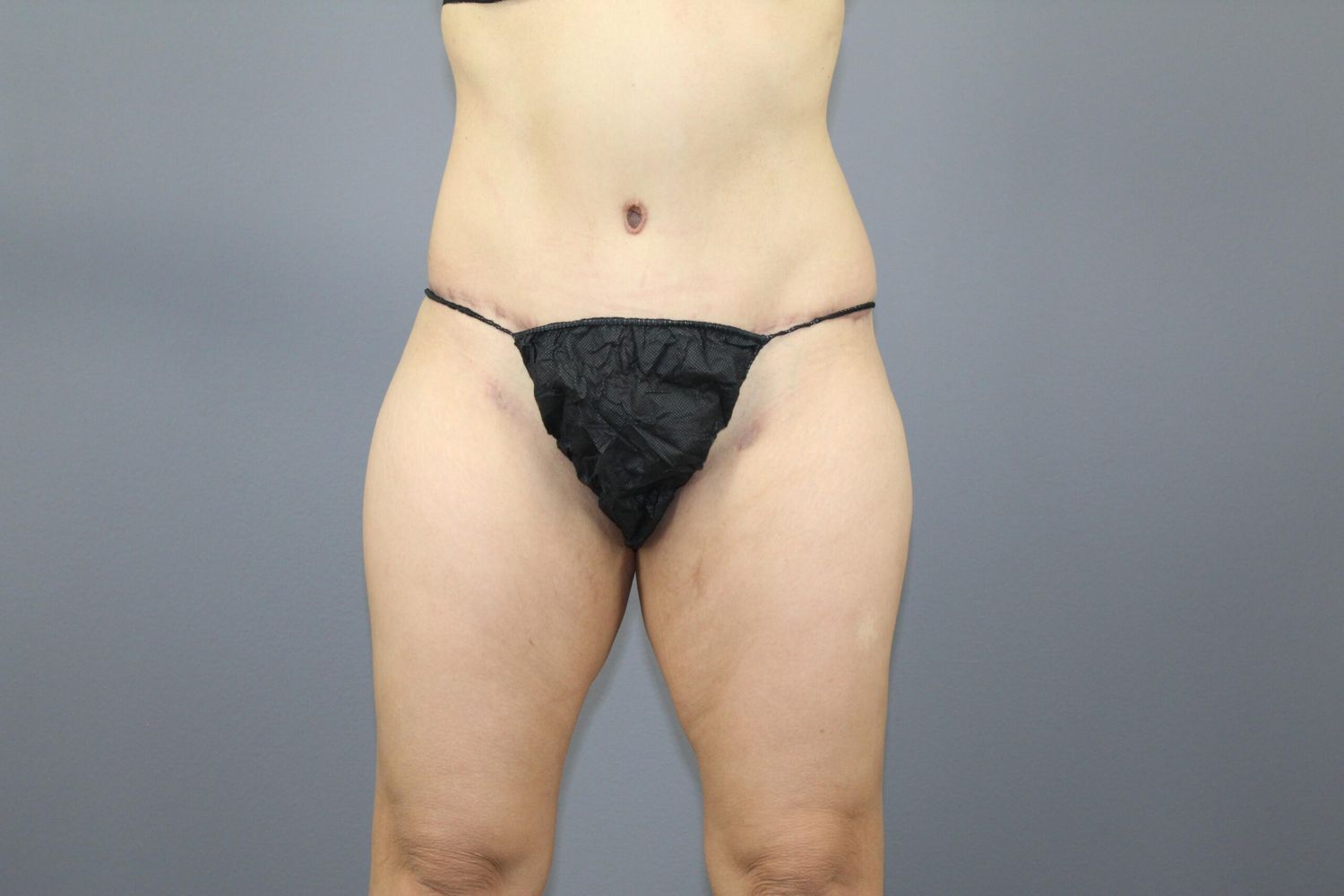 Body Contouring Before & After