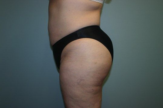 Body Contouring Before & After