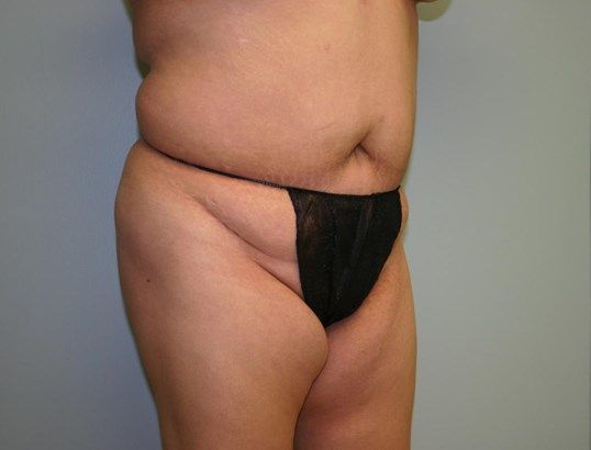 Body Contouring Before & After