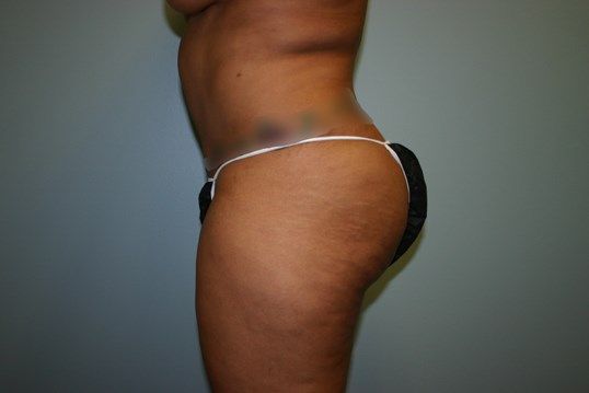 Body Contouring Before & After