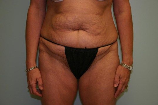 Body Contouring Before & After