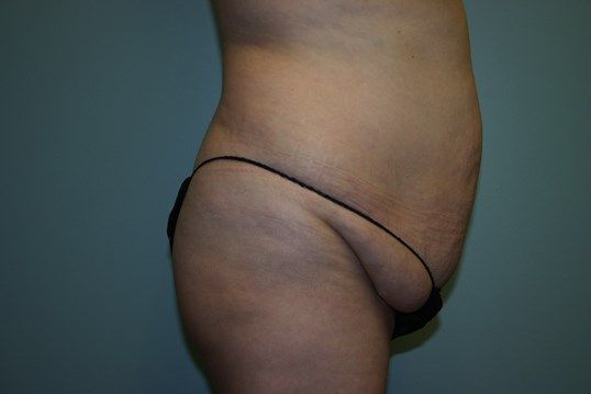 Body Contouring Before & After