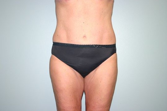 Body Contouring Before & After