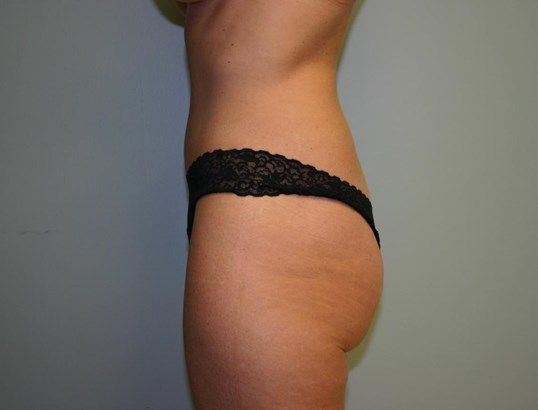 Body Contouring Before & After