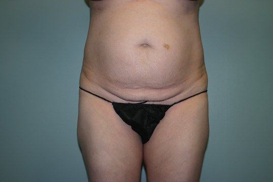 Body Contouring Before & After