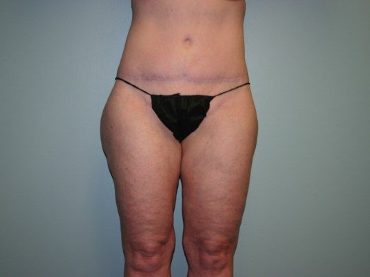 Body Contouring Before & After