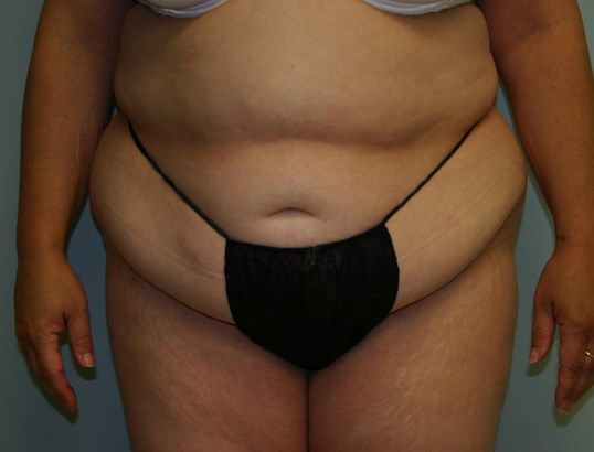 Body Contouring Before & After