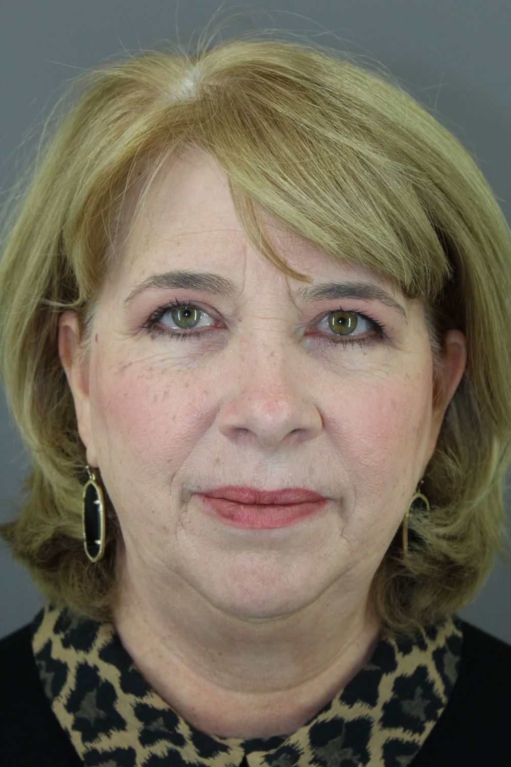 Face Lift Before & After