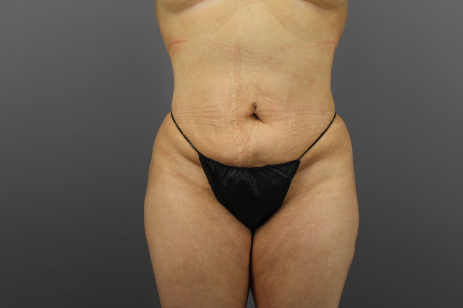 Brazilian Butt Lift Before & After