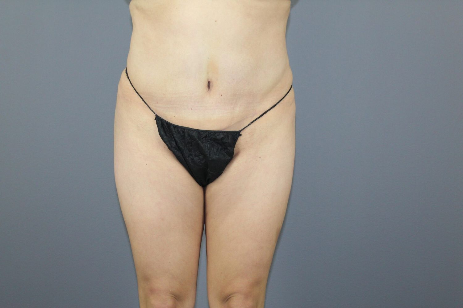 Brazilian Butt Lift Before & After