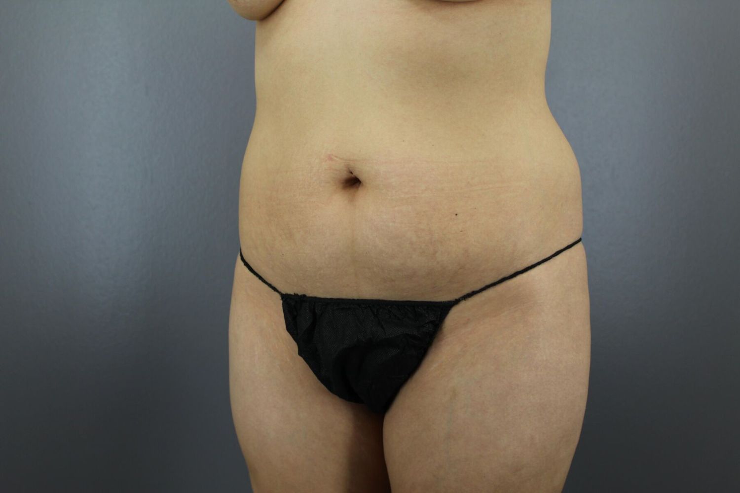 Brazilian Butt Lift Before & After