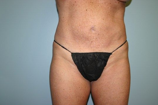 Brazilian Butt Lift Before & After